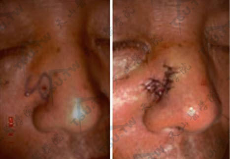 图C-2：鼻背部基底细胞上皮瘤切除“Z”皮瓣成形