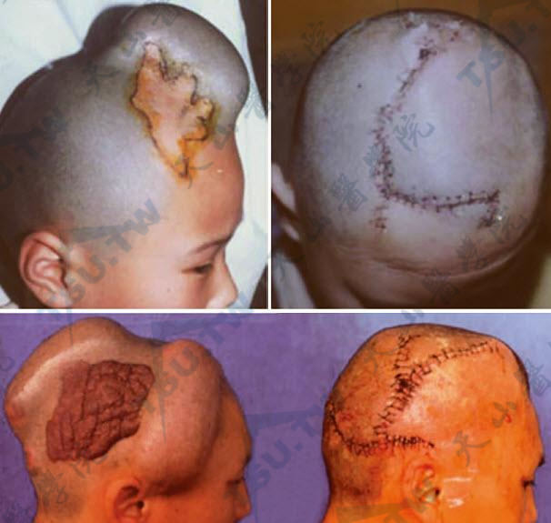头皮瘢痕与血管瘤的皮肤扩张术应用