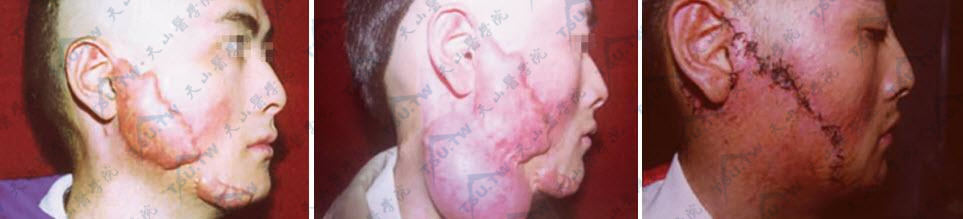 面颈部瘢痕疙瘩治疗的皮肤扩张术应用