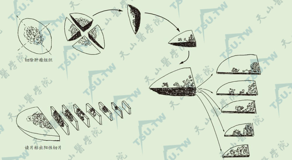 Mohs外科组织学检查的水平面切片