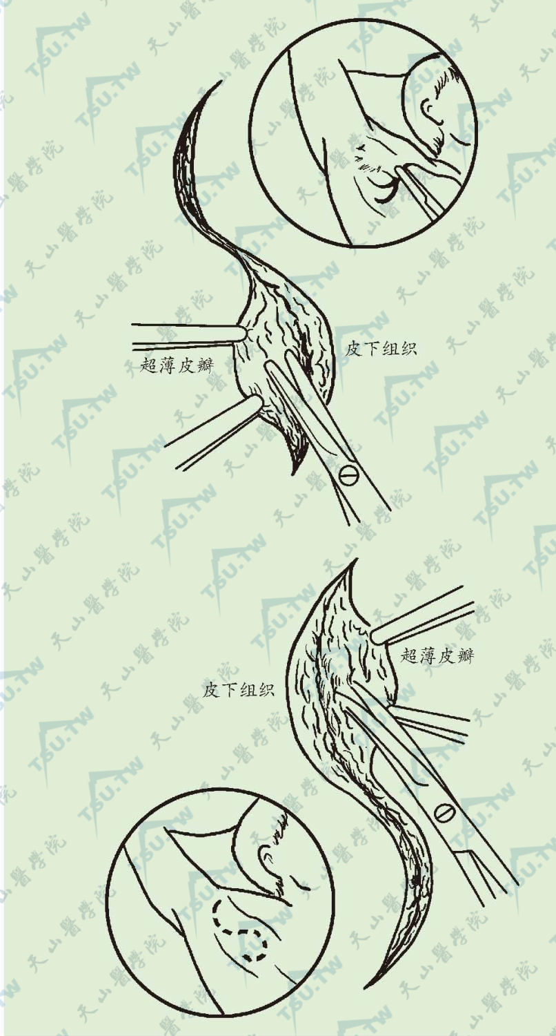 S形切开薄皮瓣法