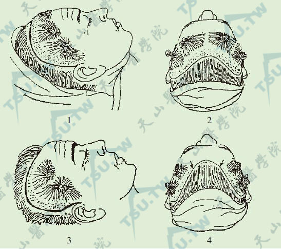 额颞部除皱术切口线设计