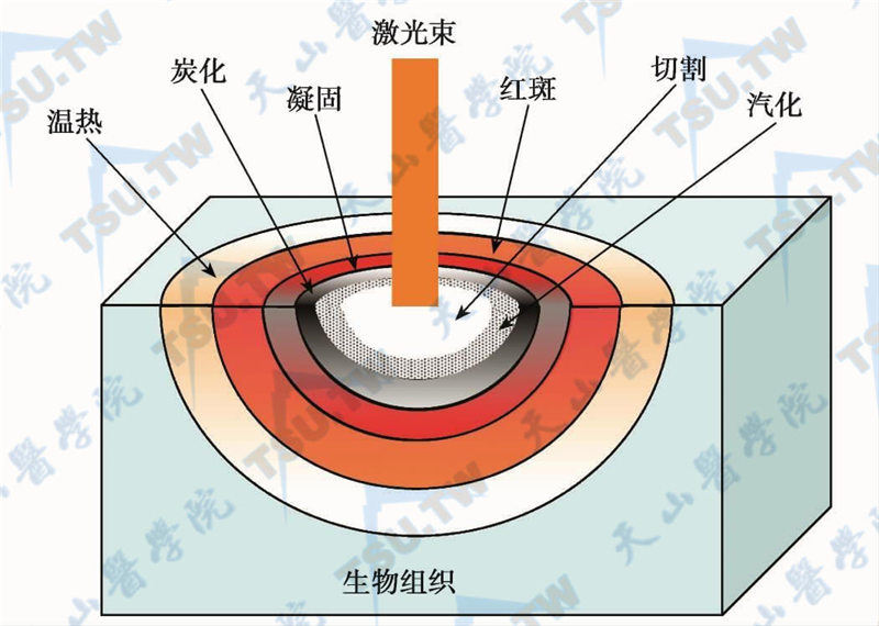 激光在生物组织中不同区域的热效应