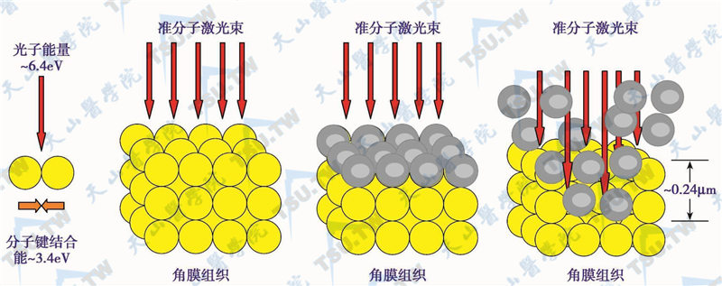 准分子激光的蚀除原理图