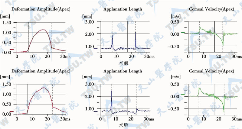同一被检者术前及术后的眼角膜变形幅度、扁平长度、回弹速率波形图