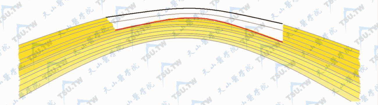 不同手术方式制作眼角膜瓣后示意图