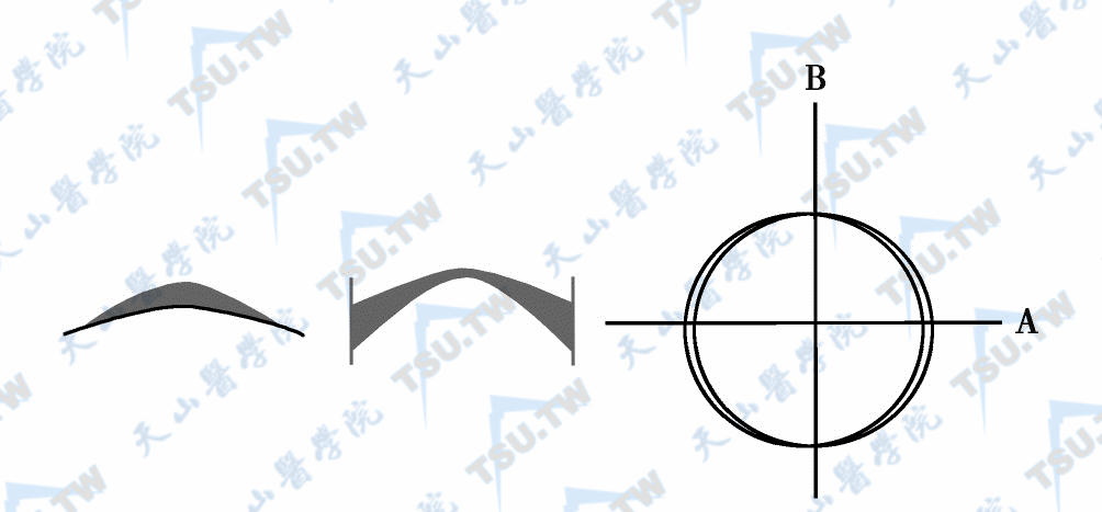 SMILE手术基本原理示意图