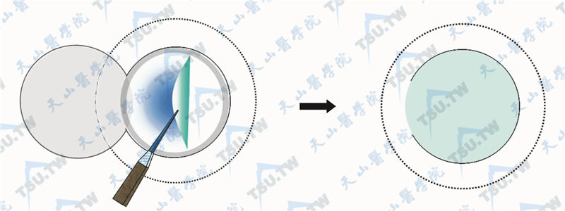 FLEx手术示意图