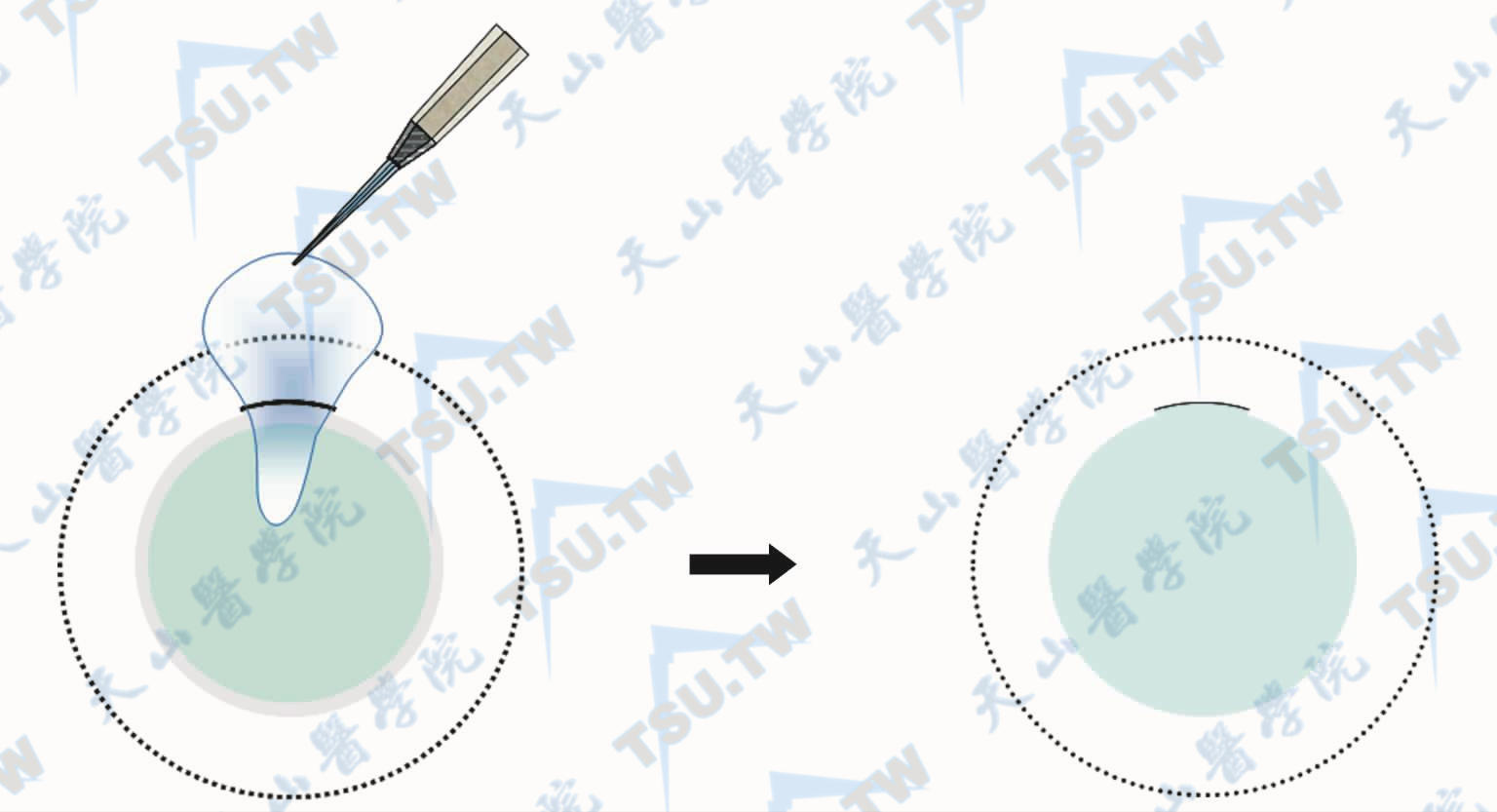 SMILE手术示意图