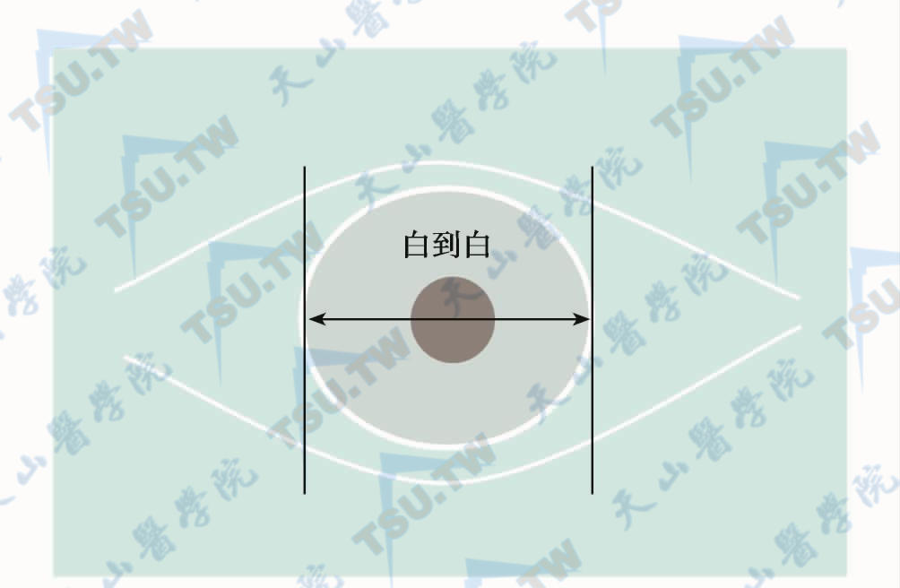 SMILE全飞秒手术治疗包（负压吸引环）选择原则