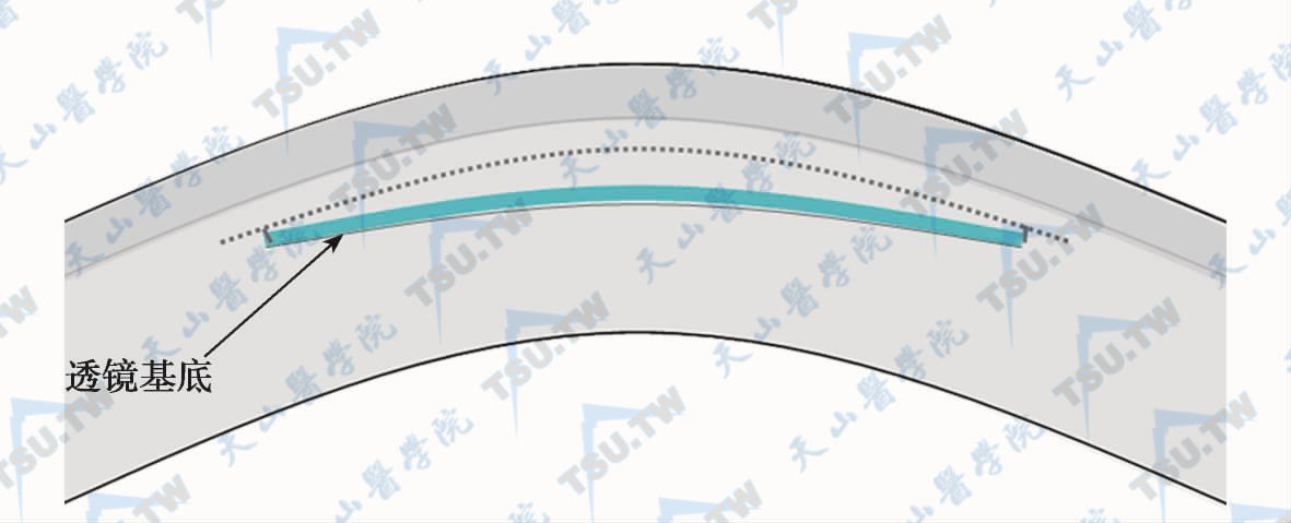 SMILE手术微透镜设计：蓝色代表微透镜基底