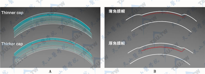 角膜帽（cap）厚度对角膜不同层次的生物力学影响（A）和屈光矫正效果（B）的可能影响