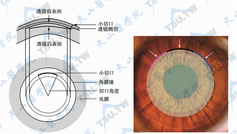 SMILE手术切口位置及弧长