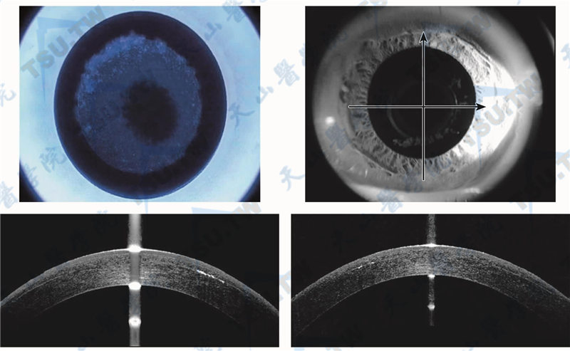 SMILE手术中在扫描透镜基底近中央时出现黑区，检查负压环时可见有白色沉积物，OCT检查时部分中央未见扫描处