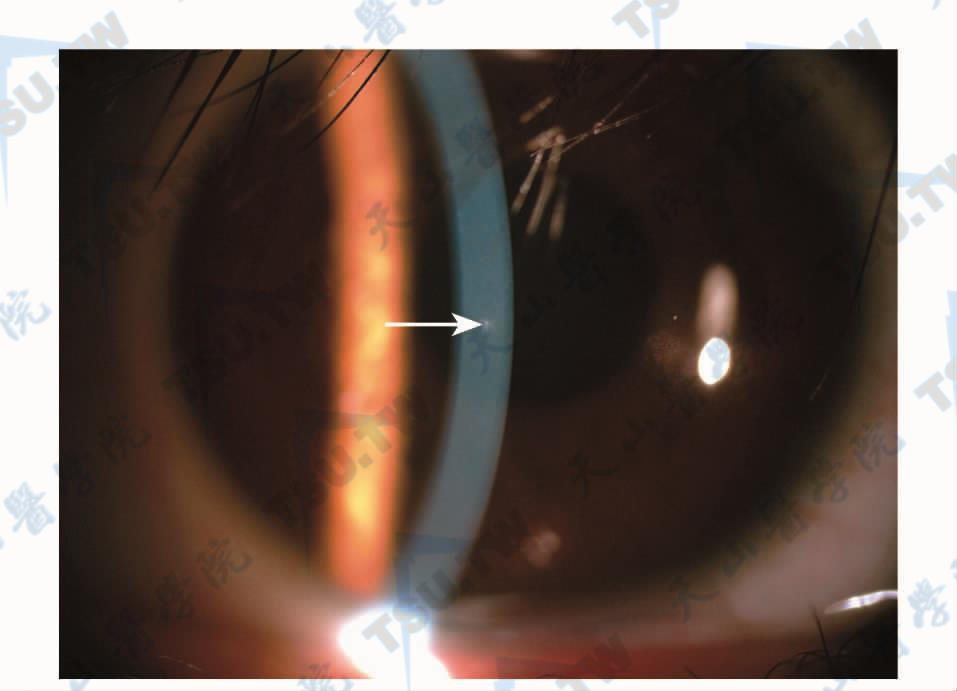 白色箭头所指为角膜帽下异物