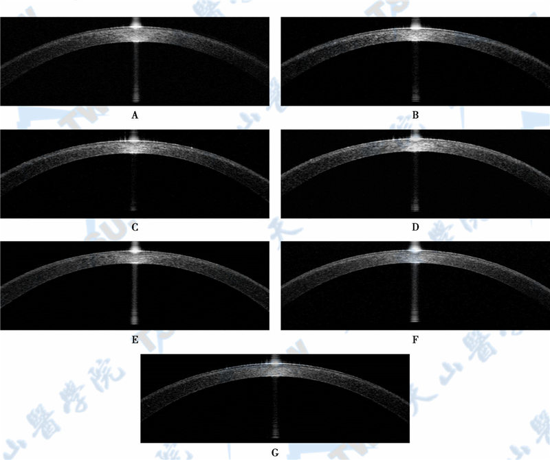 SMILE术前和术后OCT观察显示角膜透明状态逐渐恢复过程