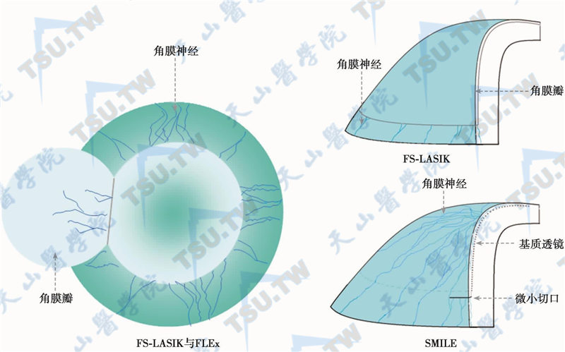 FS-LASIK、FLEx和SMILE三种术式对角膜神经的不同破坏程度