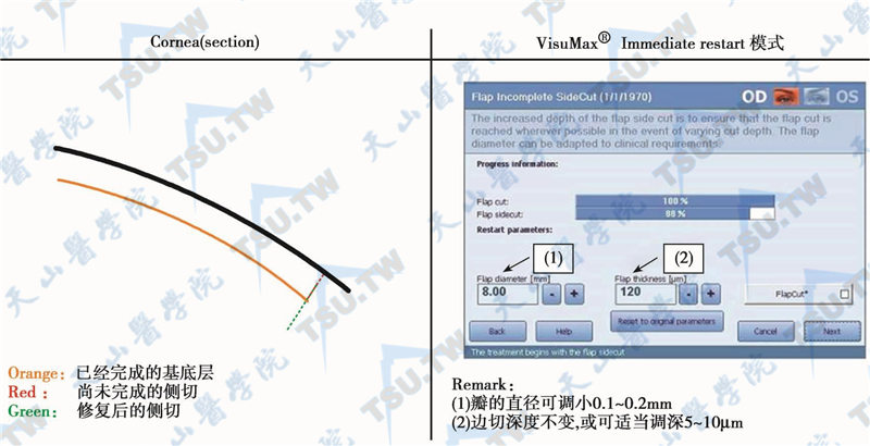 飞秒激光侧切脱环时重新设计，瓣的直径可调小0. 1～0. 2mm