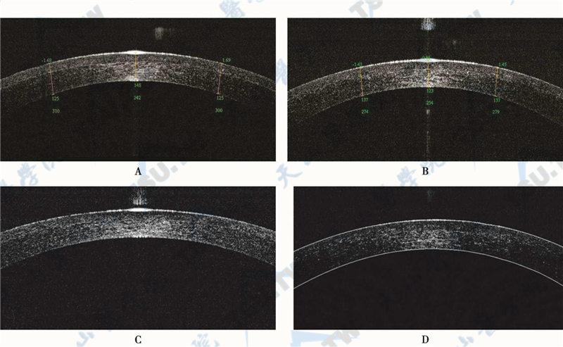 前节OCT检查，A.术后1天；B.术后1周；C.术后1个月；D.术后3个月