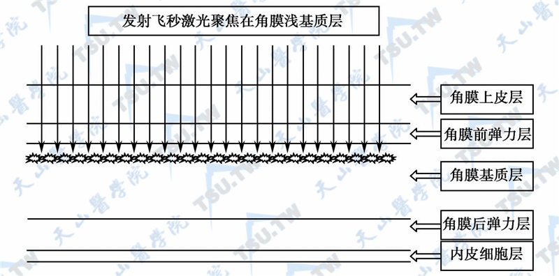 飞秒激光制作角膜瓣示意图