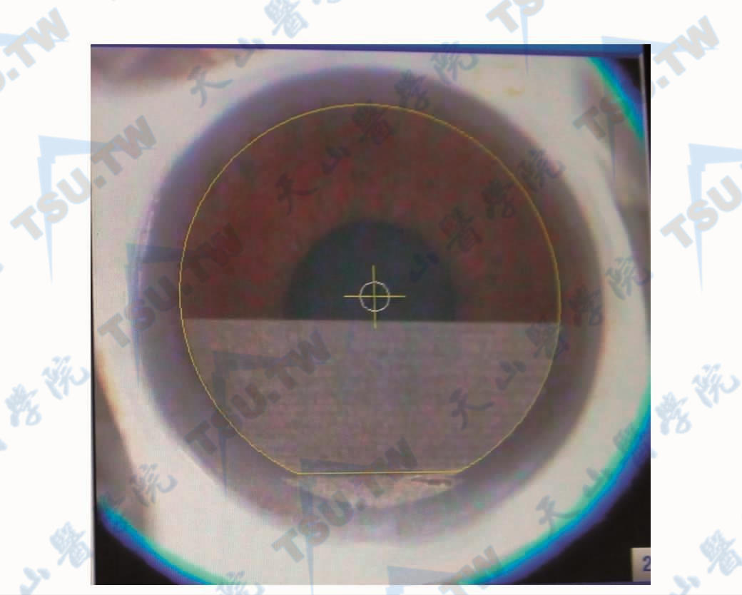 飞秒激光制作角膜瓣时参数设施及激光扫描的过程