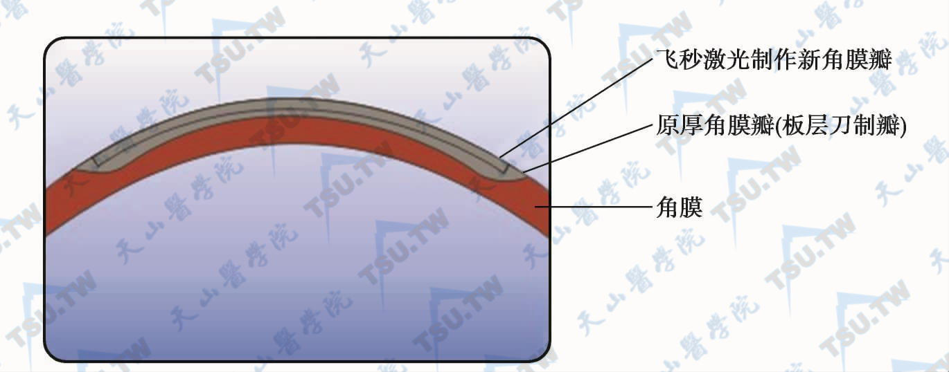 原角膜瓣厚度160～180μm内飞秒激光制作100μm瓣