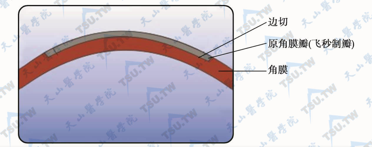 在飞秒激光制作的原角膜瓣内做环状边切