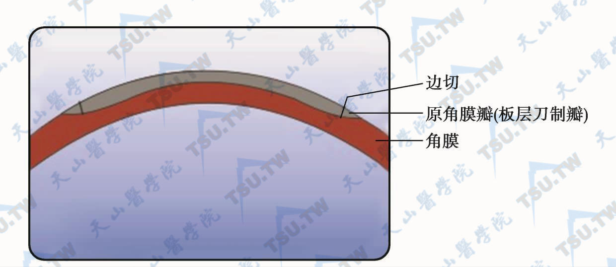 在机械板层刀制作的原角膜瓣内做环状边切