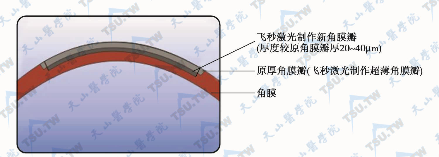 飞秒激光辅助下的LASIK手术后进行加强手术时，新瓣厚度大于原瓣厚度