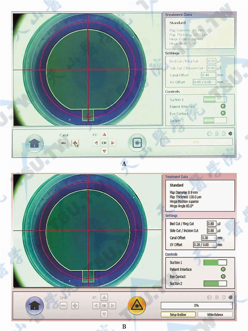 负压2绿色条形以及模拟的角膜瓣区域和隧道