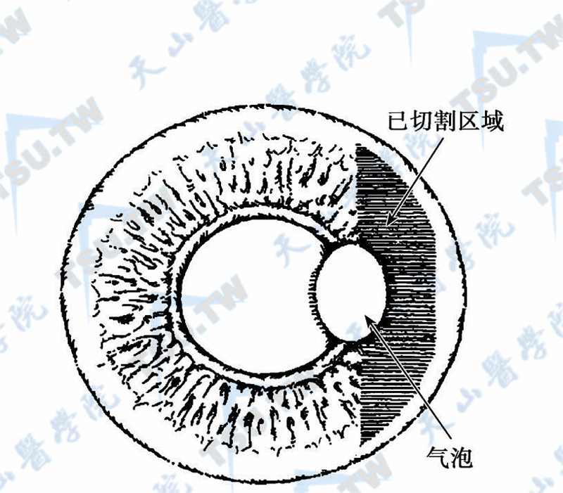 气泡突破角膜上皮