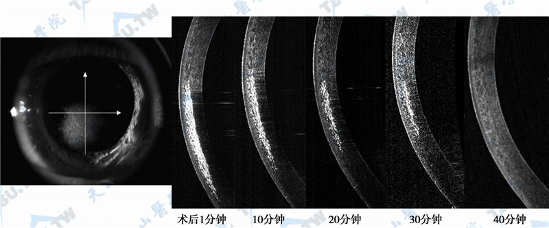 出现OBL后1分钟、10分钟、20分钟、30分钟及40分钟后气泡消失过程