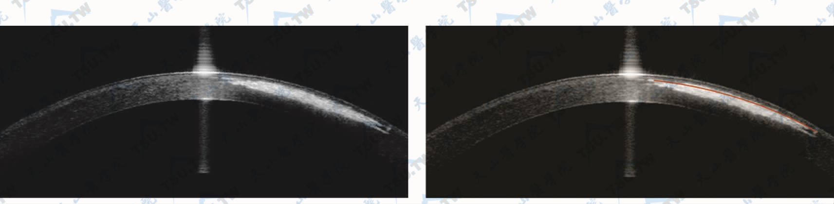 FS-LASIK手术中OBL进入瓣上角膜组织后可能会产生掀瓣困难