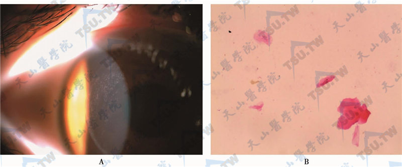 术后角膜瓣边缘呈现白色细小颗粒状碎屑，A.裂隙灯下表现；B. HE染色后光镜下表现（×40）
