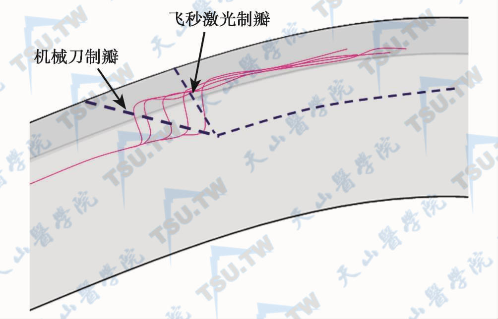 飞秒激光与机械性角膜板层刀制瓣过程中对角膜神经损伤程度的不同