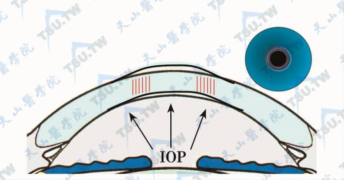 Intracor手术原理