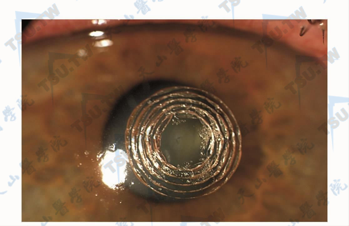 飞秒激光矫正老视眼手术（Intracor）基本步骤