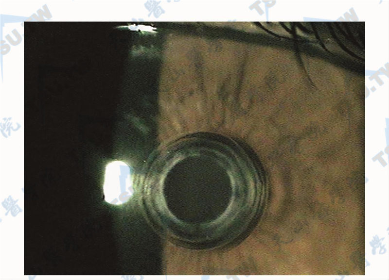 飞秒激光矫正老视眼手术（Intracor）疗效及并发症