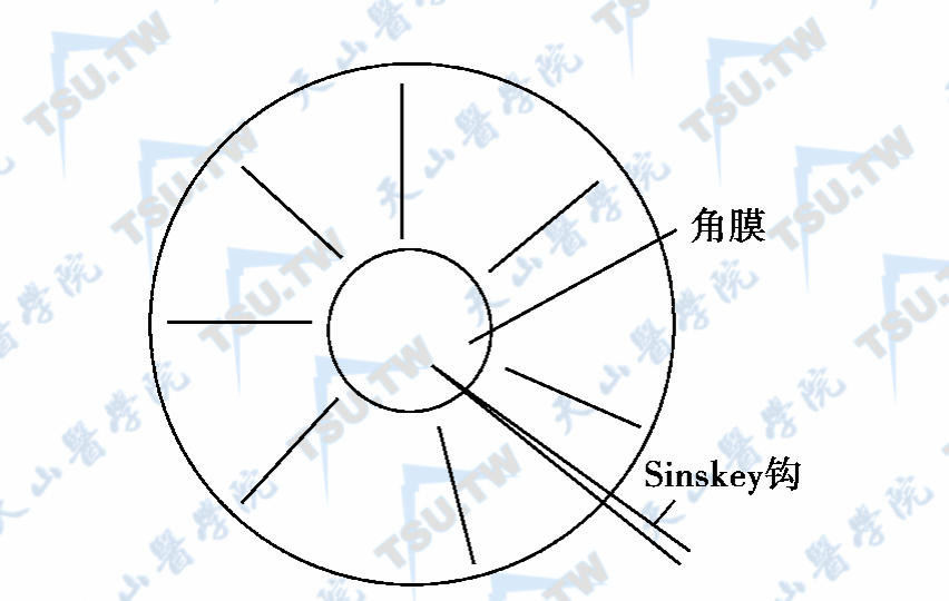 ICRS：飞秒激光介导角膜基质环植入手术步骤