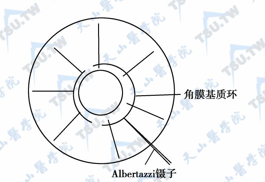 使用Albertazzi镊子植入角膜基质环