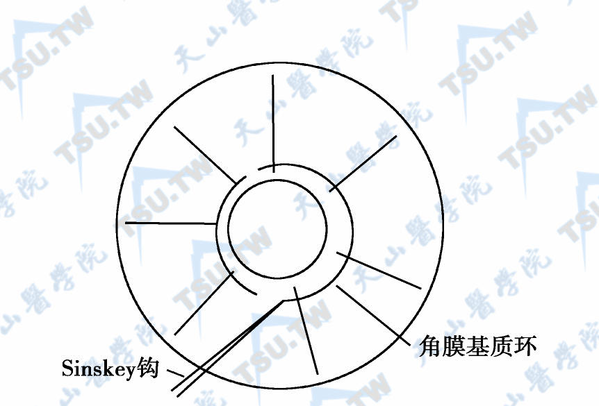 使用Sinskey钩把环调整到正确的位置