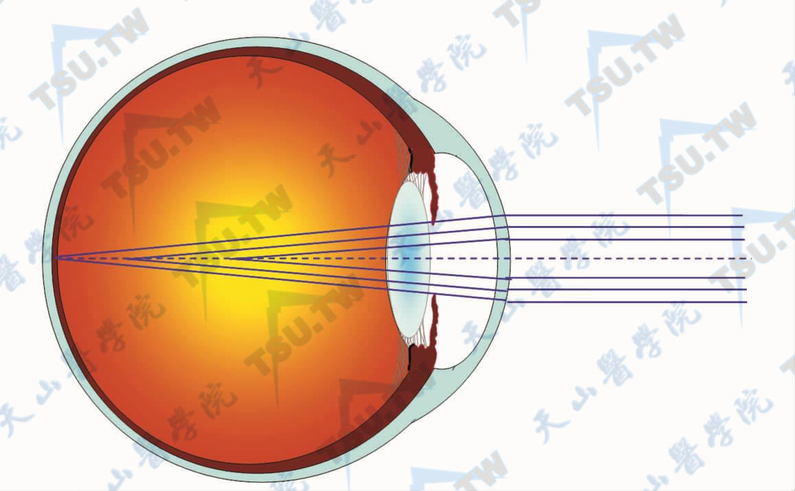 近轴光线较远轴光线更早聚焦的示意图