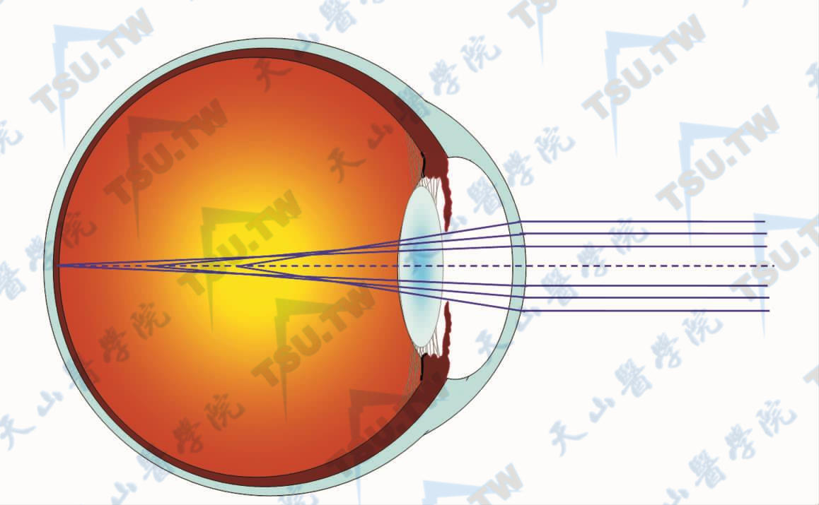 远轴光线较近轴光线更早聚焦示意图