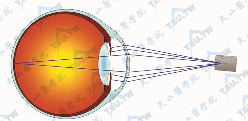 近反射引发的瞳孔缩小遮蔽了“负责”看远的远轴光线