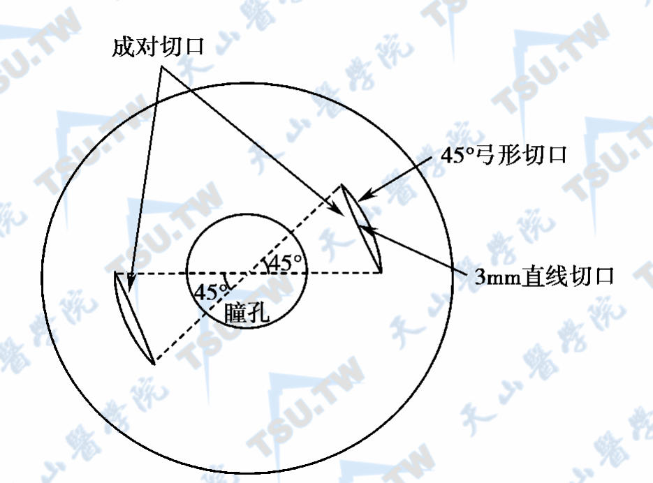 45°弓形切口与3mm直线切口示意图