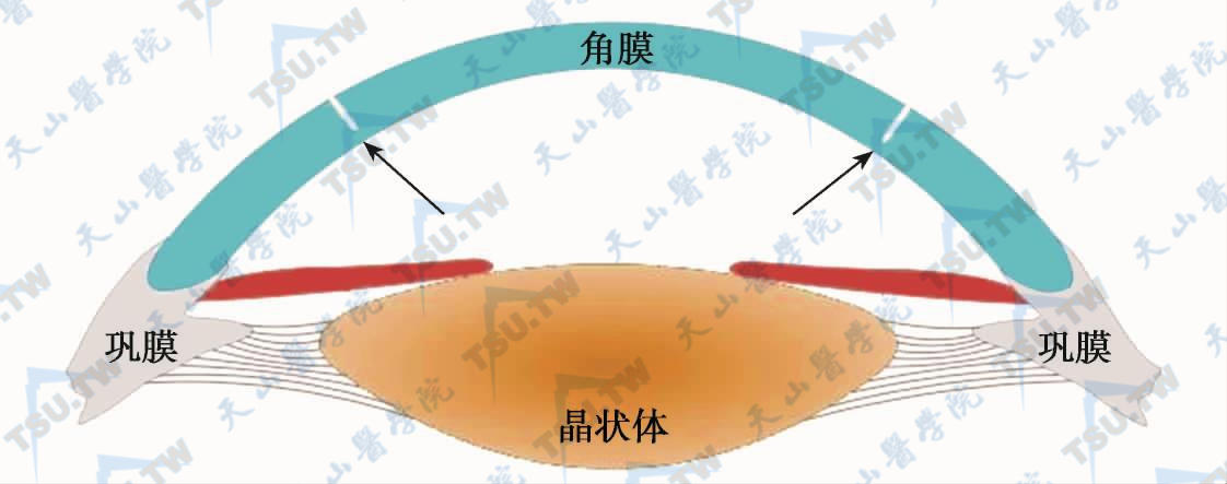 角膜开放性切削