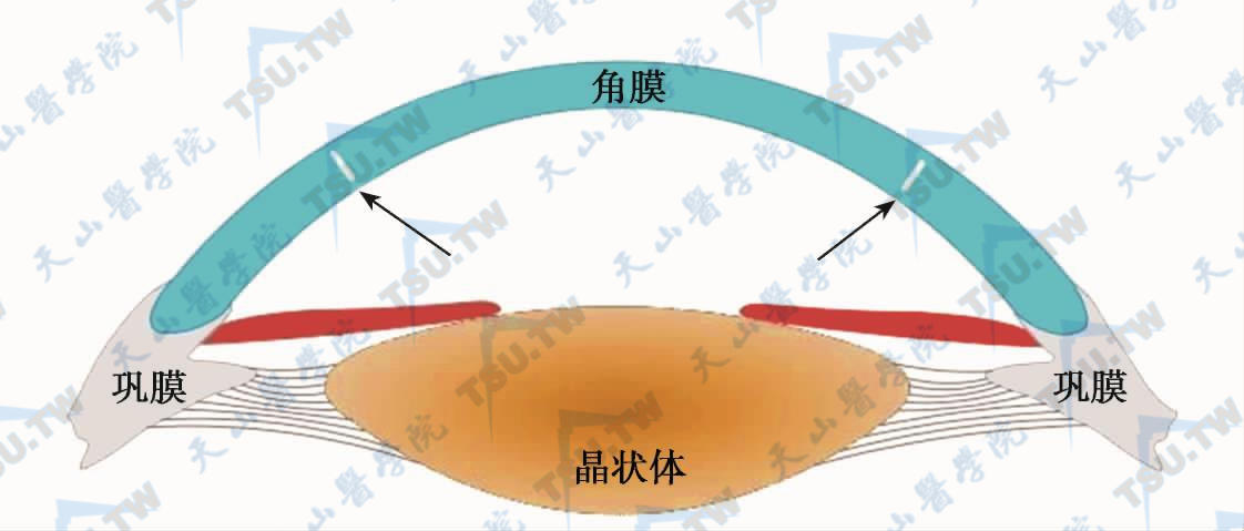 角膜基质内切削