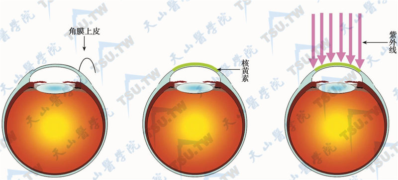 手术步骤示意图