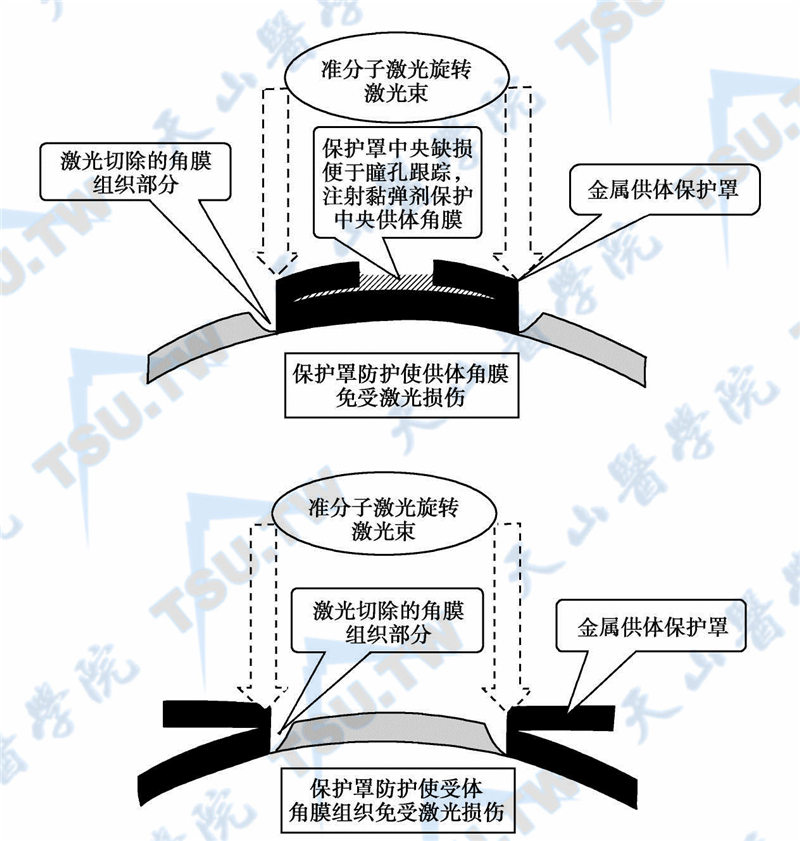 准分子激光辅助的穿透性角膜移植供体角膜制作和植床制作示意图