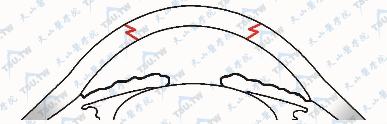 之字形边切